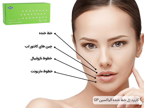 نواحی خط خنده، خطوط نازولبیال و ماریونت روی صورت