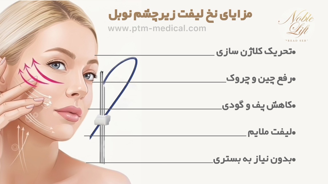 نخ لیفت چشم مونو نوبل