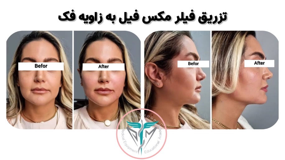 عکس تزریق فیلر مکس فیل