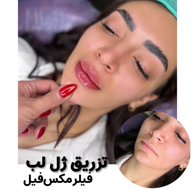 تزریق ژل لب با فیلر مکس فیل