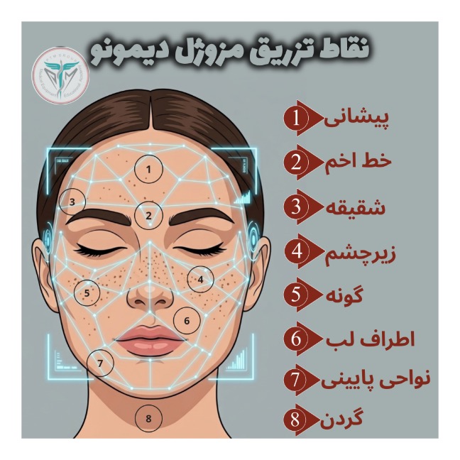 نقاط تزریق مزوژل دیمونو: پیشانی، خط اخم، شقیقه، زیر چشم، گونه، اطراف لب و گردن