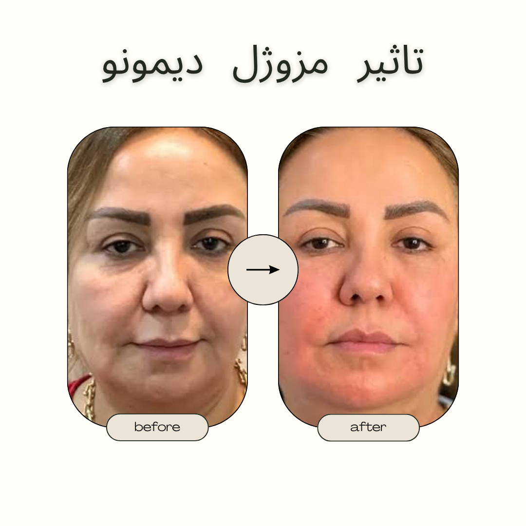 قبل و بعد تأثیر مزوژل دیمونو روی پوست صورت