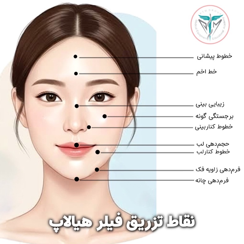 نقاط تزریق فیلر هیالاپ ۱۰ سیسی روی صورت