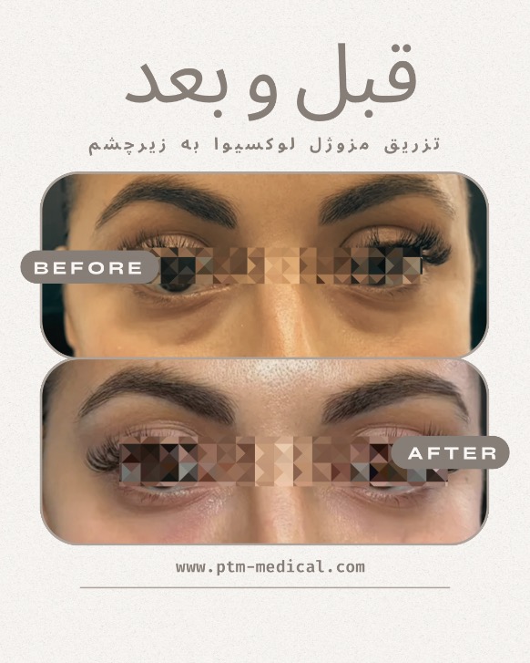 تزریق مزوژل لوکسیوا به زیر چشم