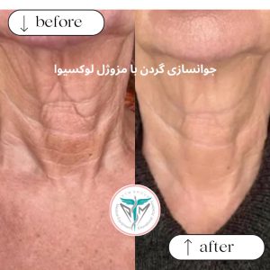 قبل و بعد جوانسازی گردن با مزوژل لوکسیوا