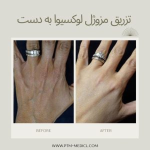 قبل و بعد تزریق مزوژل لوکسیوا به پشت دست