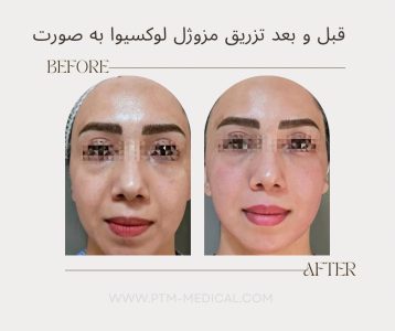 قبل و بعد تزریق مزوژل لوکسیوا به صورت