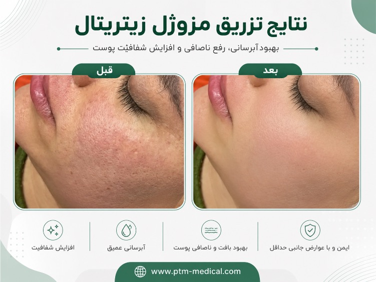 قبل و بعد تزریق زیتریتال