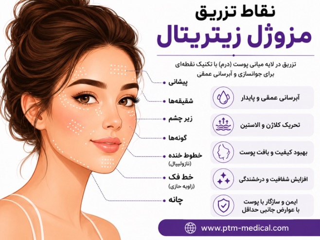 نقاط تزریق زیتریتال