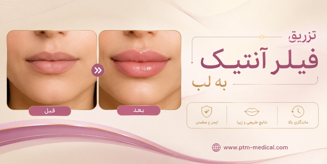 تزریق فیلر آنتیک به لب